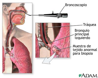 Broncoscopio