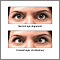 Ojos bizcos (estrabismo)