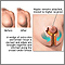 Mamoplastia
