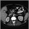 Colecistolitiasis