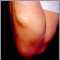 Lipoma en el brazo