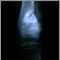Rayos X de un sarcoma osteogénico