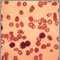 Leucemia linfocítica crónica; vista microscópica