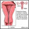 Biopsia endometrial
