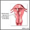 Tumores fibroides