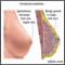 Papiloma intraductal