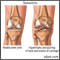 Osteoartritis
