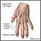 Osteoartritis