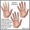 Fenómeno de Raynaud