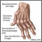 Artritis reumatoide