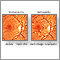 Retinopatía diabética