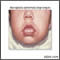 Macroglosia