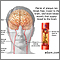Aterosclerosis de la arteria carótida interna