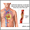 Angina estable