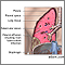 Efusión pleural