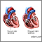 Regurgitación tricuspídea