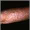 Queratosis actínica en el brazo