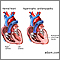 Cardiomiopatía hipertrófica