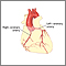Angioplastia coronaria con balón - Serie