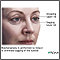 Blefaroplastia - Serie