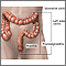 Colitis ulcerativa