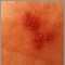 Primer plano de herpes simple