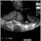 Ultrasonido de una placenta normal - Braxton Hicks