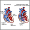 Canal auriculoventricular (defecto de relieve endocárdico)