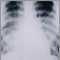 Pulmonía aguda por varicela - Rayos X de tórax
