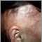Alopecia bajo tratamiento