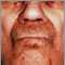 Amiloidosis en la cara