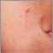 Esclerosis tuberosa; angiofibromas de la cara