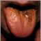 Lengua negra peluda