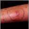 Celulitis
