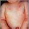 Dermatitis atópica en un bebé