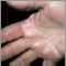 Hiperlinearidad de la dermatitis atópica de la palma de la mano