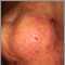 Dermatitis herpetiforme en el codo
