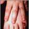 Epidermólisis bullosa distrófica dominante