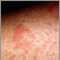 Primer plano del eczema atópico