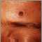 Histoplasmosis, diseminada en paciente HIV