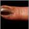 Cáncer de piel o melanoma en la uña del dedo de la mano