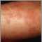 Ronchas (urticaria) en el brazo