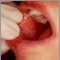 Liquen plano en la mucosa oral