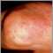Granuloma anular en el codo
