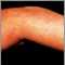 Herpes zoster (culebrilla) en el brazo