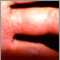Herpes zoster (culebrilla) en la mano y dedos