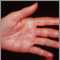 Herpes zoster (culebrilla) en la mano