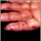 Dermatitis herpetiforme en la mano