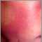 Queratosis pilaris rubra faceii
