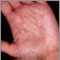 Hiperlinearidad de la dermatitis atópica